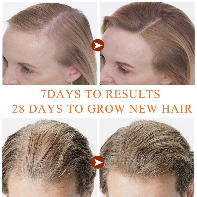 PURC טבעי צמיחת השיער המהות מעבה לצמיחה מחודשת סרום טיפולי שמן מהר לגדול שיער על נשירת שיער, מוצרי טיפוח לגברים & נשים